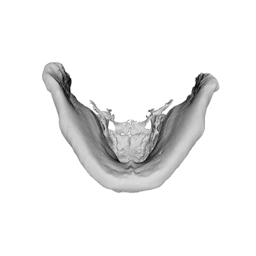 Impacted Wisdom Teeth, 3D Model — Image 2 of 2