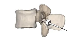 Устройство для электростимуляции спинного мозга. Device for electrostimulation of the spinal cord.
