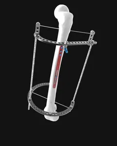 аппарат Илизарова + накостная пластина xternal fixation device and plate