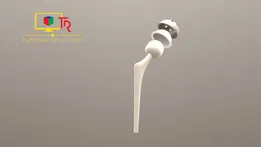 Hip prosthesis