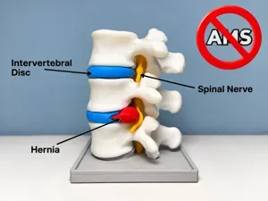 (NO AMS) Herniated Disc - Lumbar Spine