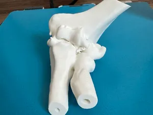 Dubberley 3A Coronal Shear Fracture Distal Humerus