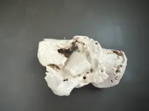Calcaneus fracture (Sanders 3AB classification)