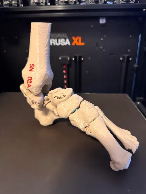 Talus fracture - Hawkins III. — Фото 3 из 8