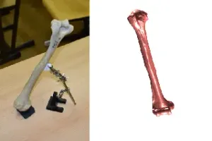 Upper Arm Bone Scan - Humerus (R)