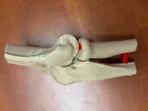 Human elbow - Coronoid fracture