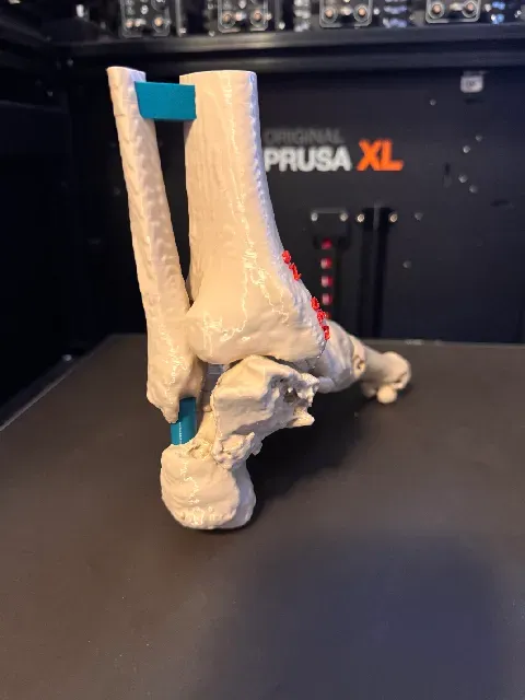 Talus fracture - Hawkins III. — Фото 8 из 8