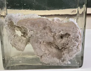 Chondrosarcoma of the Pelvis — 3D Anatomical Specimen (Bone Tumor Series)