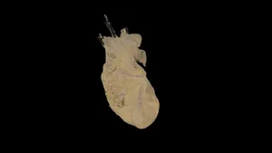 Perfusion Fixed Human Heart Donation #207