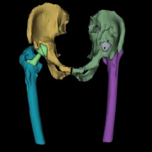 Pelvis 3D Protesis bilateral