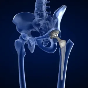 Potosís cadera (hip prosthesis)